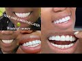 MY BAD EXPERIENCE + WASTE OF MONEY WITH VENEERS --- I HAD TO GET THEM RE-DONE | EXPLAINED
