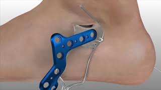 Acumed Surgical Technique  - Mini Calc Plating System