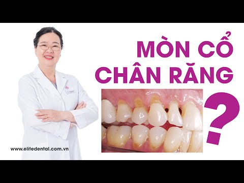 Video Mòn cổ chân răng và cách khắc phục - youtube