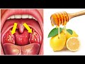 وصفة رائعة و مجربة في علاج التهاب اللوزتين في المنزل بالليمون 🍋|  tonsillitis treatment for adults