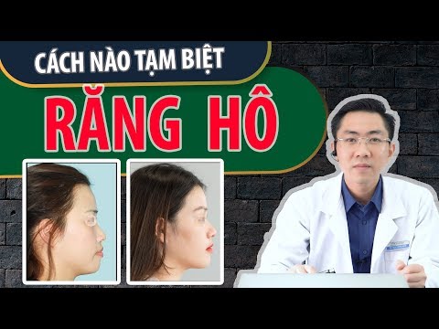 Video Case #10: Sự Thay Đổi Khi Niềng Răng Hô Và Di Xa Toàn... - youtube