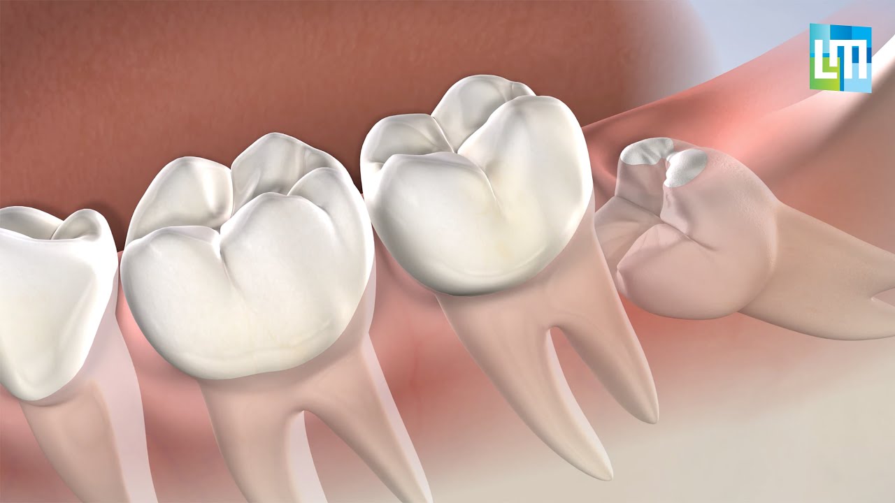 wisdom teeth before and after