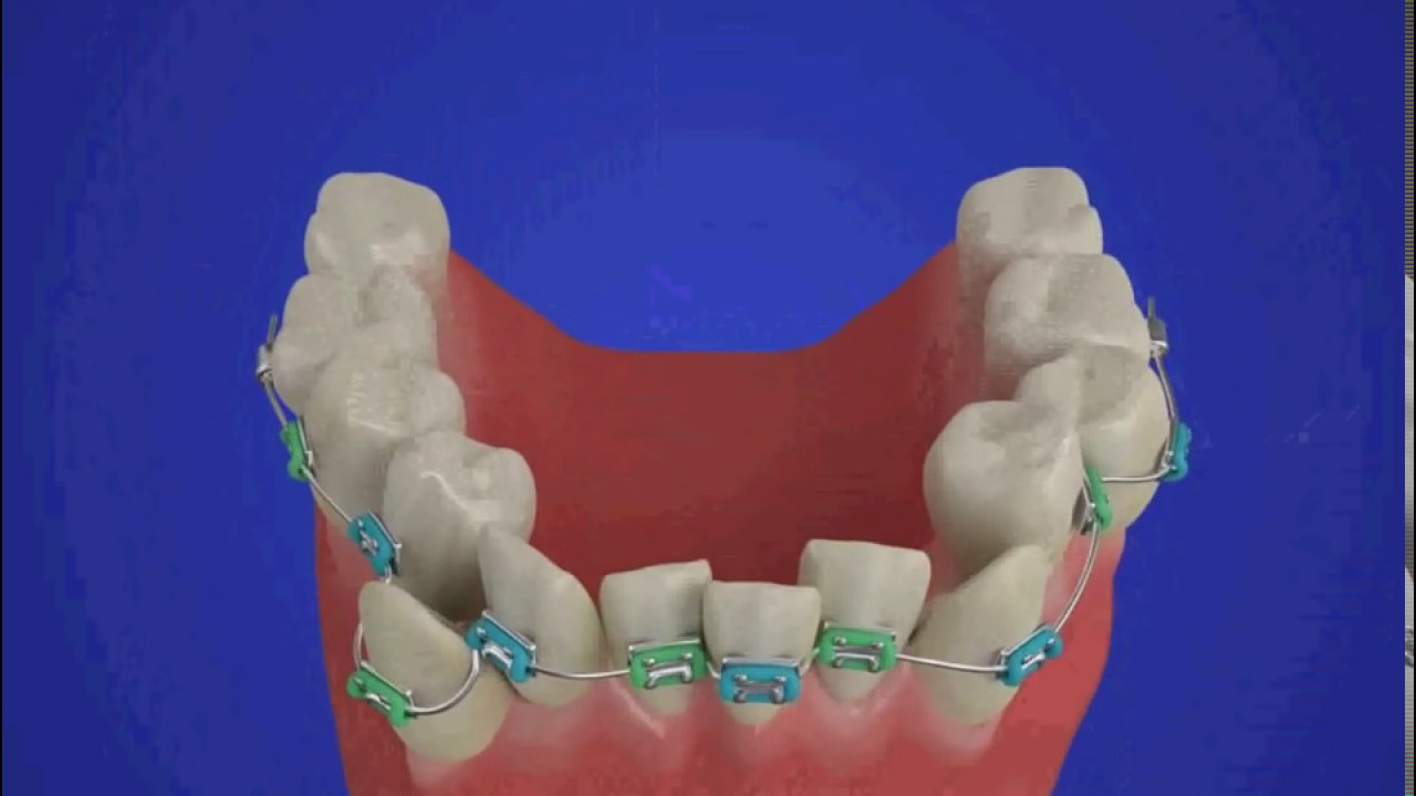 Брекет системы показания для установки виды и уход проект