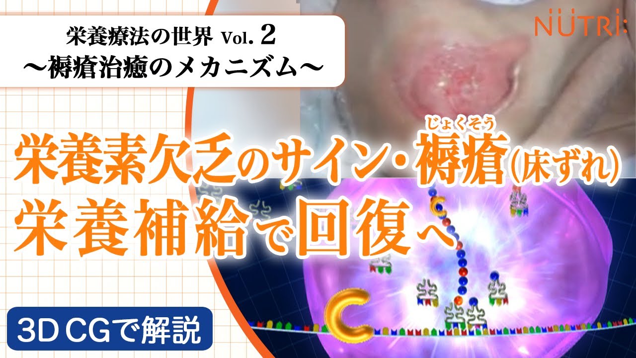  栄養療法の世界Vol.2 褥瘡治癒のメカニズム〈3D CG解説〉－栄養素欠乏のサイン・褥瘡（床ずれ）栄養補給で回復へ－ - YouTube Motiv 