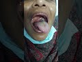 Tonsil Cancer #cancer #bangladesh #foryou #fashion #viral