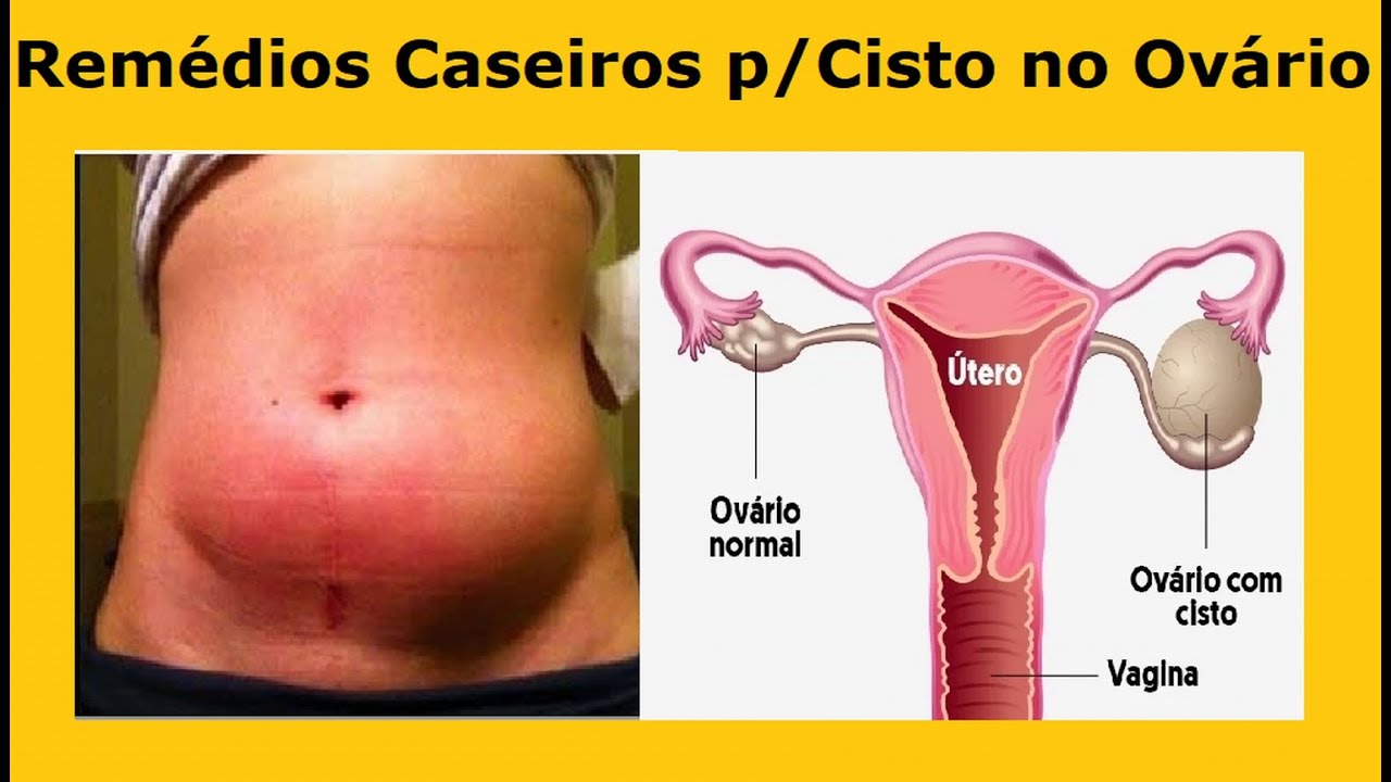 COMO ACABAR COM O SOFRIMENTO DE CISTOS NO OVÁRIO COM ESSE REMÉDIO ...