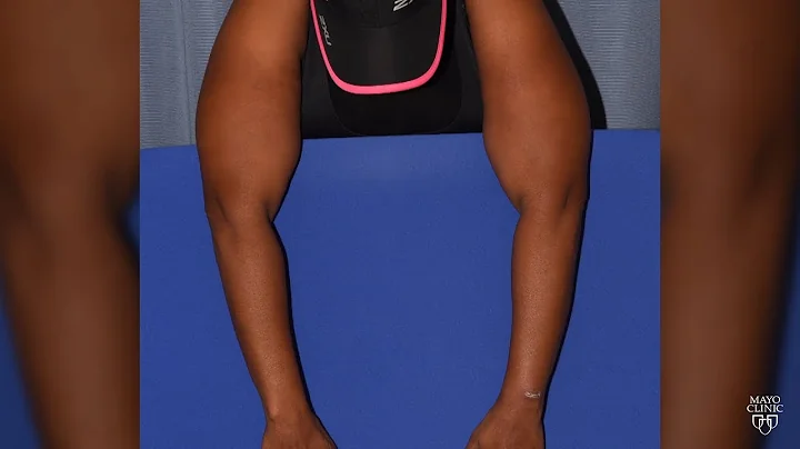 Mayo Clinic Minute: Lymphedema risk is not just about the surgery