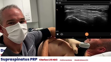 Supraspinatus PRP Injection Demonstration
