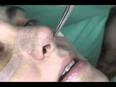 Como colocar cinta micropore en la nariz