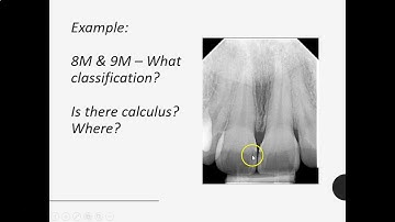 Caries Diagnosis 33 minutes