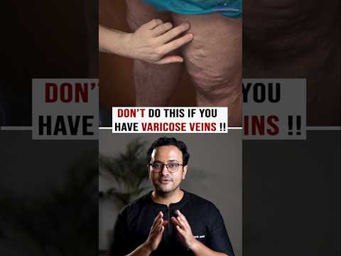 Stop Doing These Mistakes If You Have Varicose Veins!