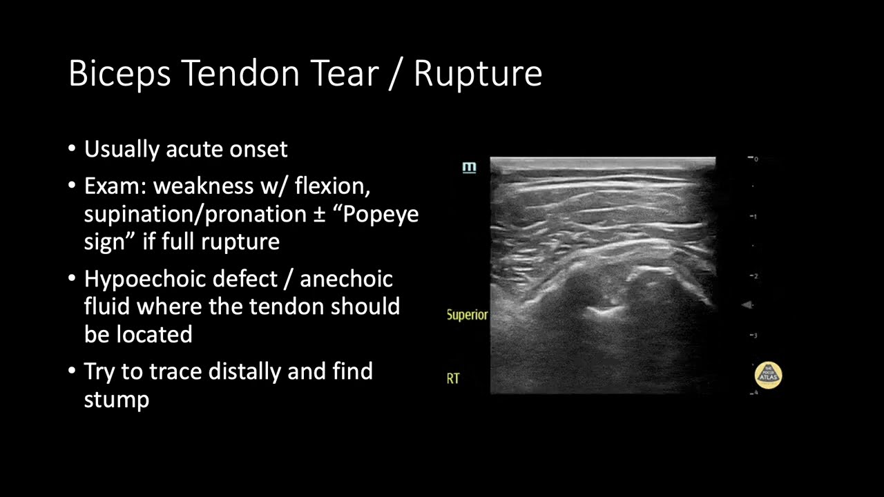 Shoulder POCUS | Scan for Rotator Cuff Tears, Bursitis & Dynamic Impingement