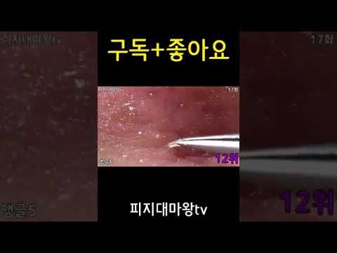 피지제거 피지뽑기 스페셜 코블랙헤드제거 #shorts