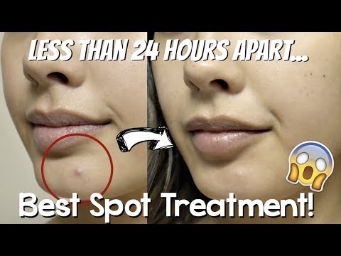 The MOST Effective and Best Way to Spot Treat Pimples | Skincare Shorts