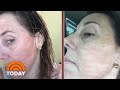 Beauty Treatments Gone Wrong: Women Sound Alarm On Risks | TODAY