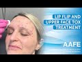 Lip flip and upper face tox treatment