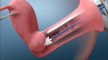 What Happens During a Pap Test?