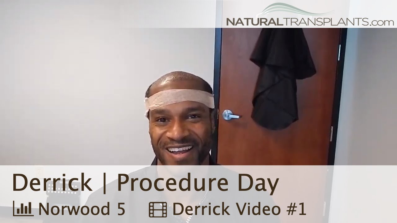 fue hair transplant month by month Black Men Hair Transplant Surgery | Natural Hair Transplant (Derrick)