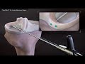 Fiberstitch allinside meniscus repair