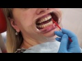 Покрытие зубов фторлаком.  Фторлак – защита зубов  от кариеса |  стоматология Сатори Самара