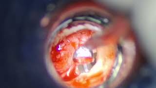 Stapedotomy with Intact Stapedius 