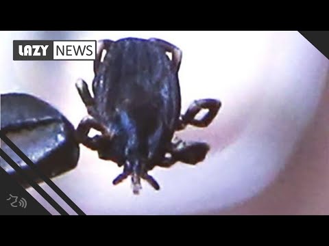 tick-removed-from-boy's-eardrum-after-he-complained-of-buzzing-noise