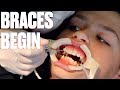 GETTING BRACES FOR THE FIRST TIME | HOW TO SHORTEN TIME WITH BRACES BY SIX MONTHS!