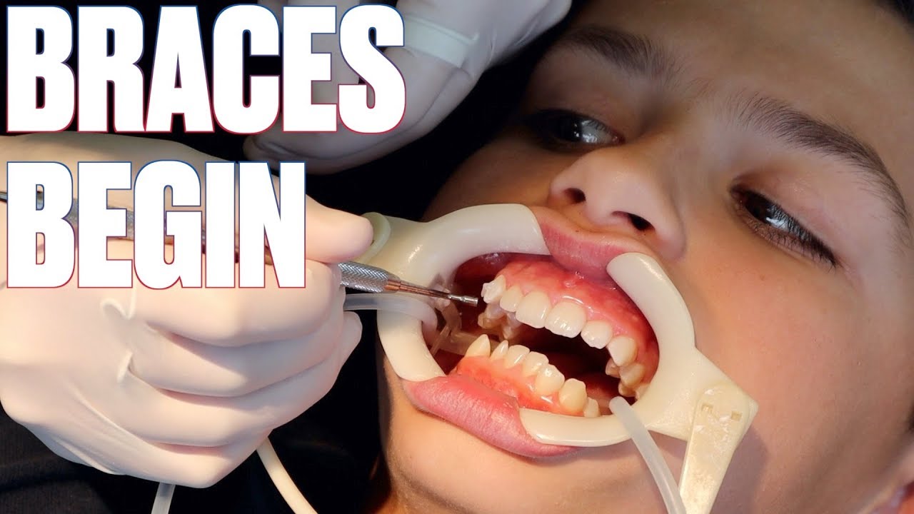 Getting Braces For The First Time How To Shorten Time With Braces By Six Months Youtube 