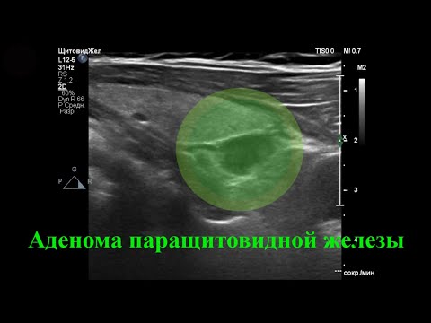 Аденома паращитовидной железы