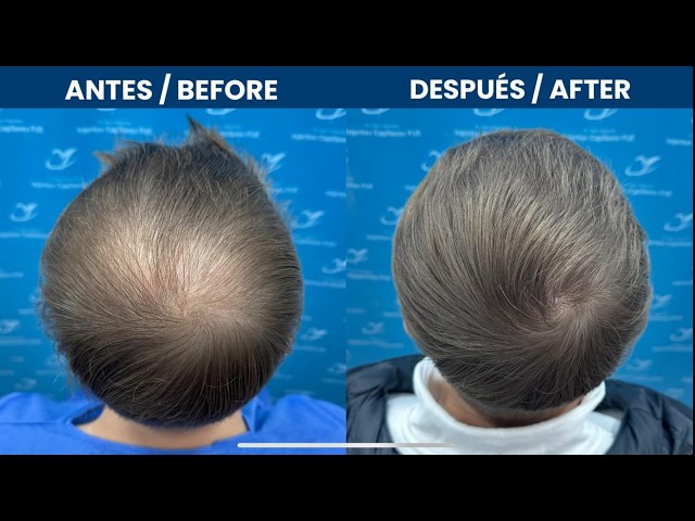 Injerto Capilar Lima 2230 folículos (5748 pelos)