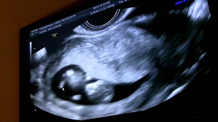 Our baby's heart beat at 11 weeks 2 days during Ul...