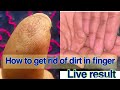How to get rid of cracked,dirty,peeled fingers || हाथों को बनाए बिलकुल ही मुलायम और बेबी सॉफ़्ट
