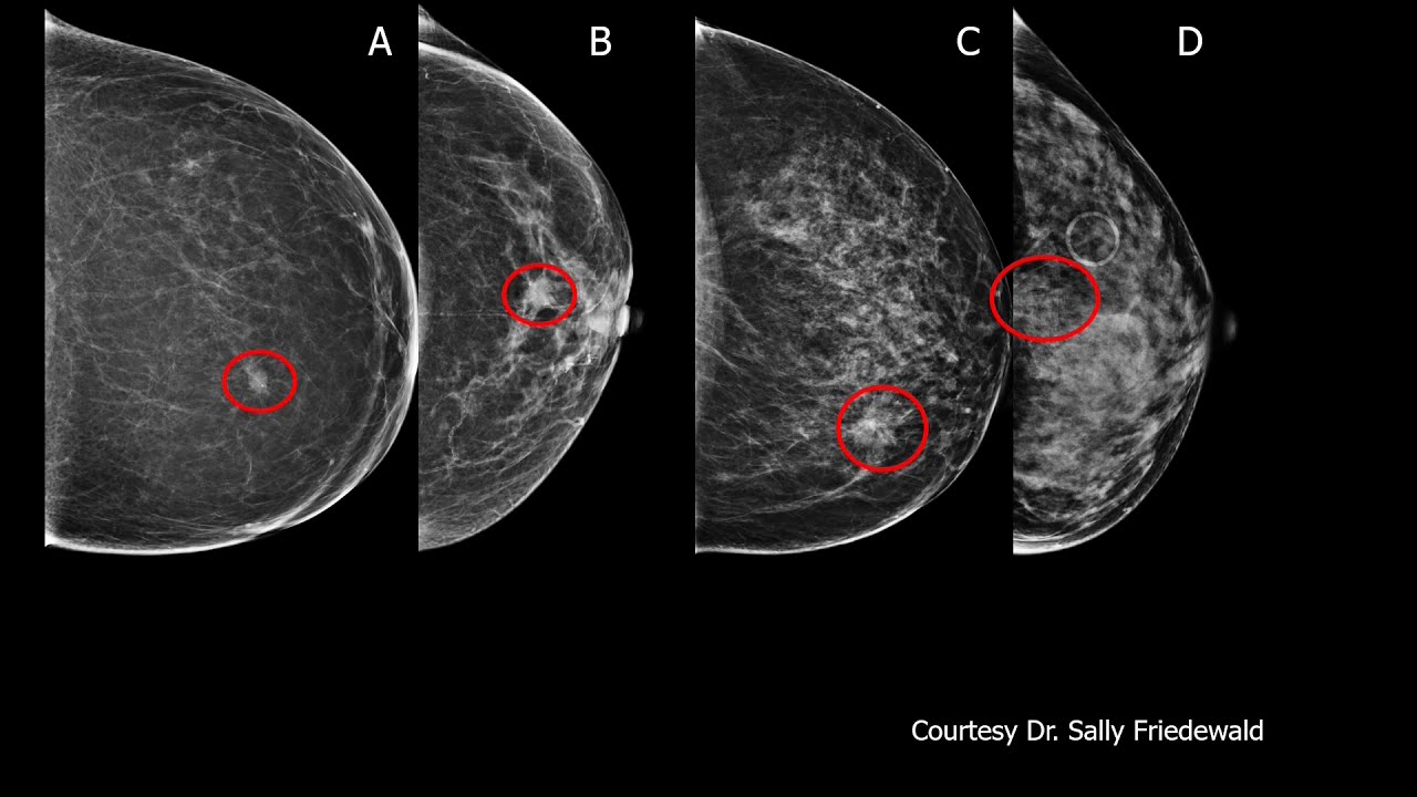Screening Algorithms in Dense Breasts