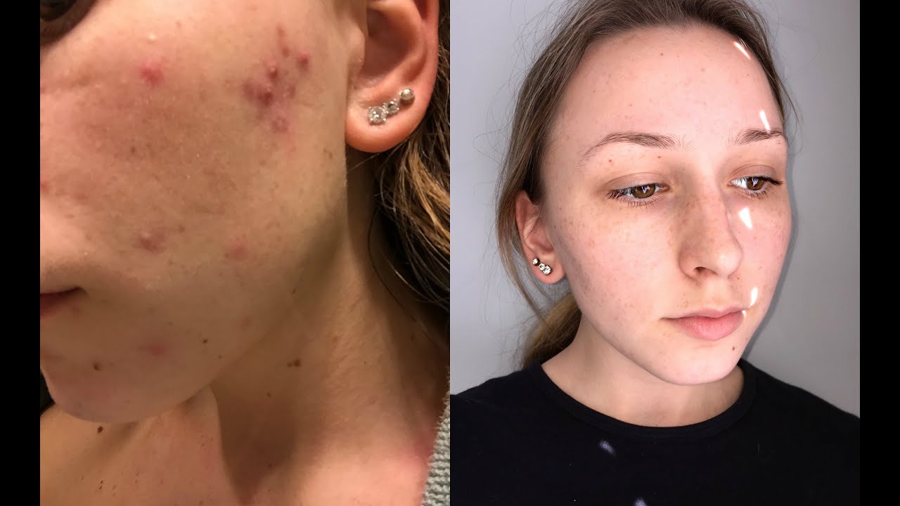 How I got my SKIN CLEAR for FREE - YouTube