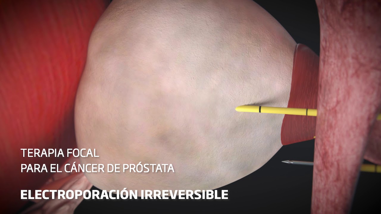 hipertrofia prostatica benigna pdf prostatita anus doare