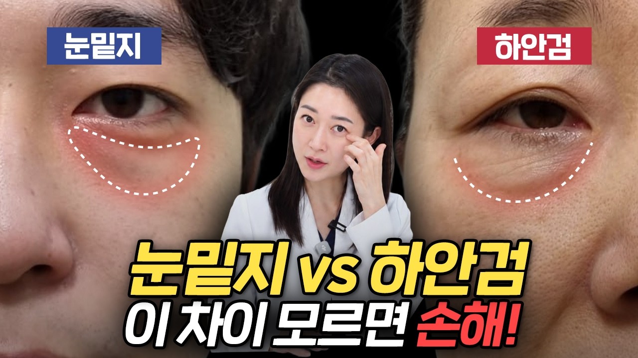 눈밑지방재배치 vs 하안검 차이점 총정리! 내 눈에 맞는 수술은?