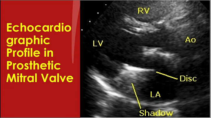 Echocardiographic profile of prosthetic mitral valve