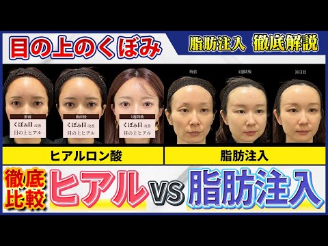 【後悔しない選び方】目の上の窪み治療！ヒアルで出目金？脂肪は溶かせない？徹底比較【症例公開】