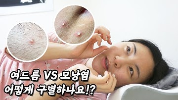 SUB)모낭염과 연고 관련 가장 많았던 질문에 답해요!! (모낭염 여드름 구분하는 방법)