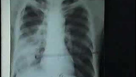 21 Th Nhiem Viem Phoi[bacsihoasung.wordpress.com].wmv