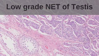 Famous Low Grade Neuroendocrine Tumour (NET) of testis - Pathology mini tutorial Net Worth