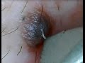 ほくろの毛を引っこ抜く！part5 Hair of a mole!
