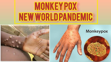 Understanding Monkeypox: What You Need to Know