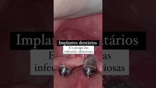 Cuidado com a Peri-implantite