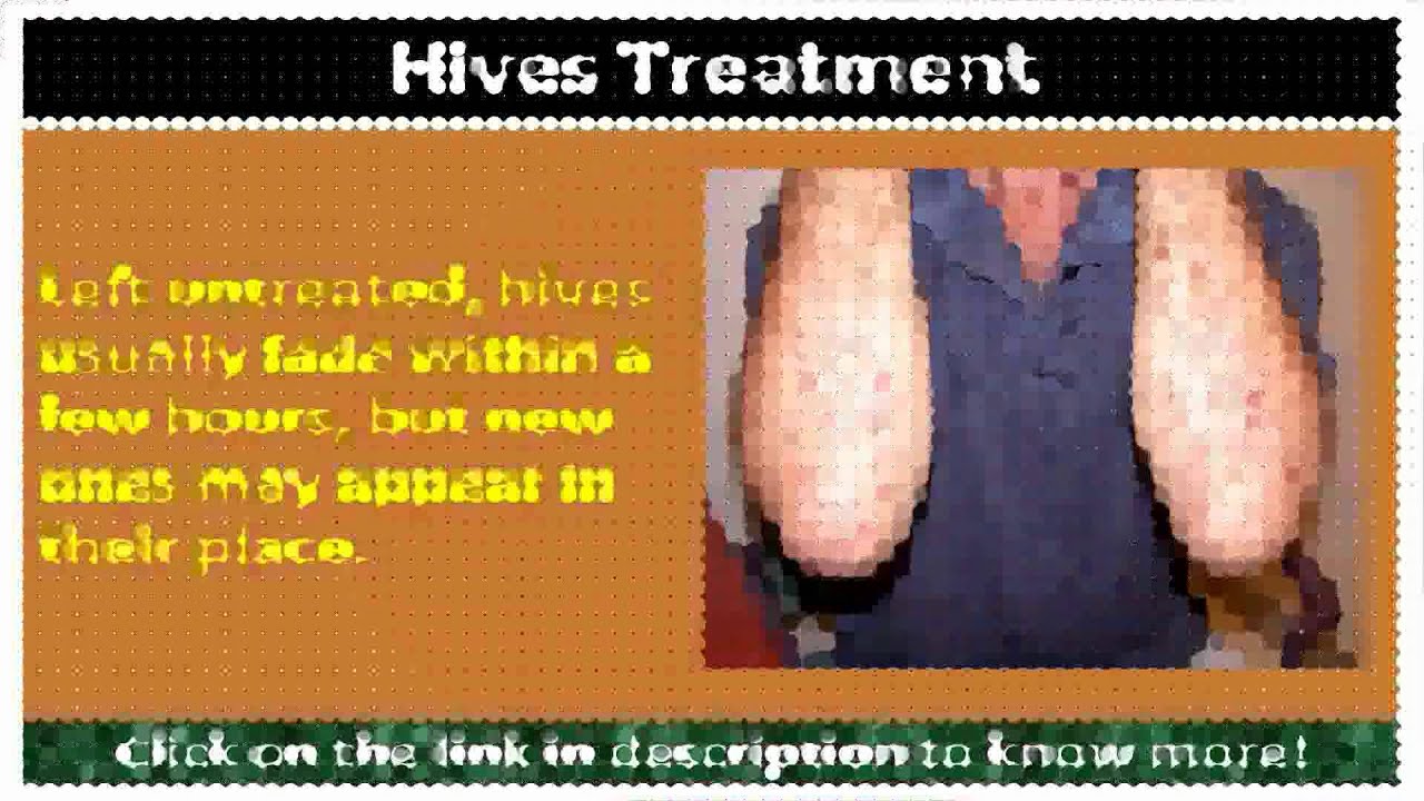 hives medical treatment