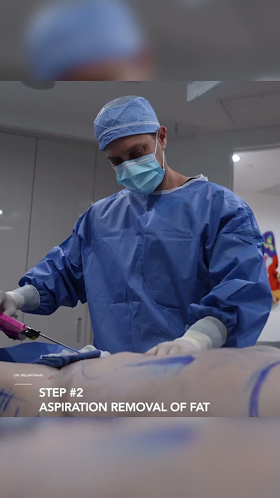 Gender Affirming Surgery - 360 Lipo & BBL with Rib Remodeling! Before & After Results!