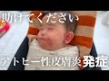 【緊急動画】アトピー性皮膚炎を発症 | 誰か助けてください😭痒がる息子を見てるのが辛すぎる