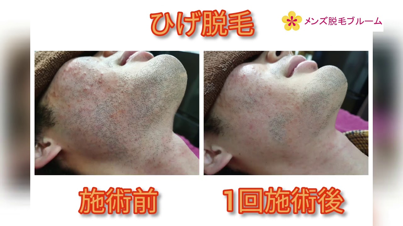 【メンズ脱毛】ひげ脱毛1回目のビフォーアフター - YouTube