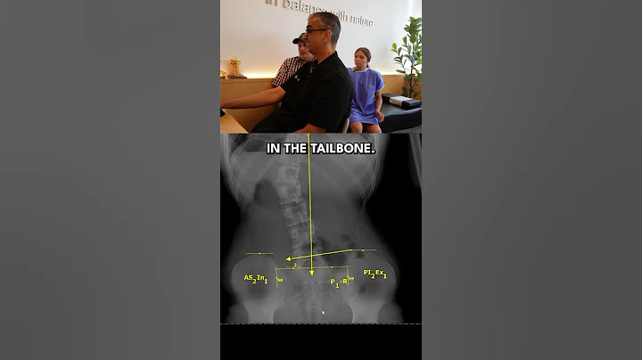 Scoliosis Back Pain Helped with Coccyx & S3 Adjustment #chiropractic #shorts