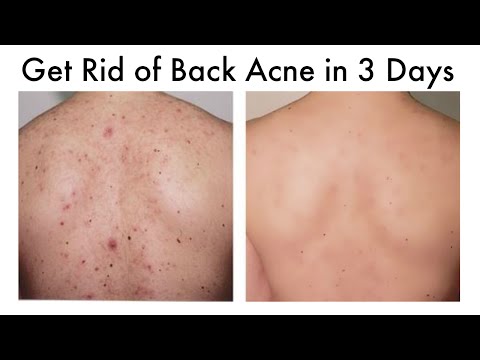 How to Get Rid of Back Acne At Home in  Days